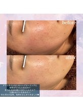 メリー(merry)/剥けないハーブピーリング♪