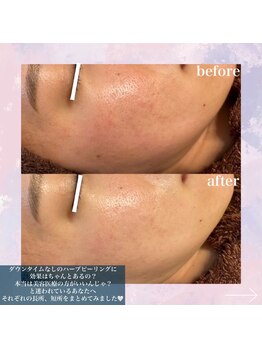 メリー(merry)/剥けないハーブピーリング♪