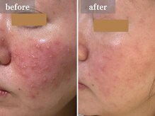 エアル(earu.)/BA|毛穴ケア|ピーリング|高円寺