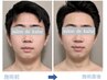 【メンズ小顔エステ】韓国最新美容レッドショットでお顔のお悩み解決！ ¥8800