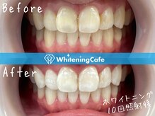 ホワイトニングカフェ アスピア明石店(WhiteningCafe)/ホワイトニングビフォーアフター