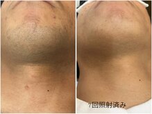 レイズ(RAISE)/メンズ人気！　ヒゲ脱毛