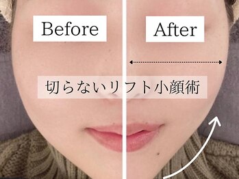 モンロー(MonroE+)/最新高周波★サーマルプロリフト