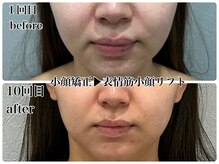エミマス ボーテ(Emimas Beaute’)/表情筋小顔リフトで法令線改善！