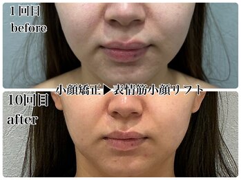 エミマス ボーテ(Emimas Beaute’)/表情筋小顔リフトで法令線改善！