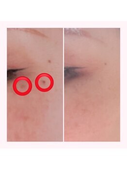 モアビューティー 紙屋町店/【White out】