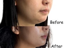 ハス(hasu.)/お顔の脂肪分解！スッキリ小顔に