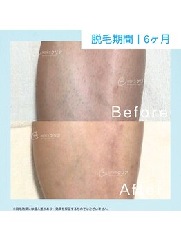 メンズクリア ららぽーと和泉店/【メンズクリア】お客様の施術例