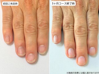 カピリナ(Ka Pilina)/自爪育成・深爪・川崎