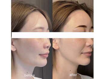 ルミライ(Lumirai)/たるみ改善|毛穴|フェイシャル