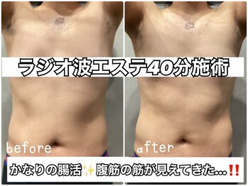 リエル(RIEL)/ラジオ波エステ