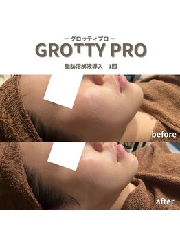 フルアナ(Hu ruana)/小顔/リフトアップ/エイジング