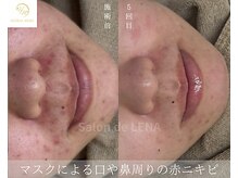 サロン ド レナ(Salon de LENA)/ハーブピーリング サロンドレナ