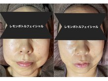 サロン フェリシア(salon Felicia)の雰囲気（レモンボトルで脂肪分解！半永久的！施術５回目のお写真♪）