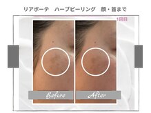 ラ ルーチェ 星田/幹細胞ハーブピーリング