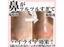 アルムダアクア 天王寺店(Aleumda AQUA)/毛穴エクストラクションプロ大阪