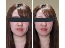 美心鍼/ビフォーアフター