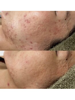 小顔アンドエイジングケア専門店 ビゼ(美sser)/REVIハーブピーリング