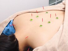 なかのぶスキップロード整骨院 鍼灸院の雰囲気（一人一人のお客様に合わせた悩みに鍼施術★）