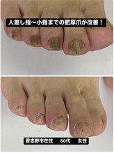 巻き爪じゅん 船橋店/肥厚爪による不快感と変色が改善