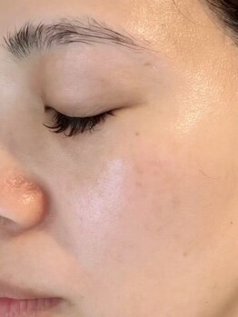 Grace の写真/ほうれい線・たるみをケア！ふっくらハリ肌で明るい印象に☆肌悩みに徹底アプローチ◎是非お試しください◇