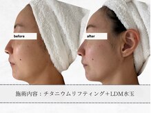 エメ(aimer)/チタニウム《小顔・引き締め》