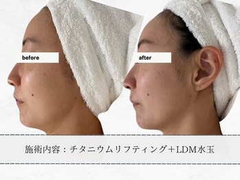 エメ(aimer)/チタニウム《小顔・引き締め》