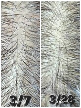 アン 銀座(ann)/頭頂部分け目エクソソーム育毛