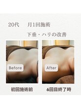東広島西条整骨院/20代　バストアップ実績