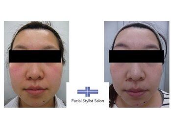 フェイシャルスタイリストサロン 高崎店(Facial Stylist Salon)/ケア例(32)