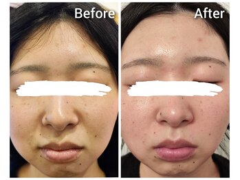 トータルボディケアアンドビューティー タイヨウ(TOTAL BODY CARE&BEAUTY TAIYO)/<フェイシャル>