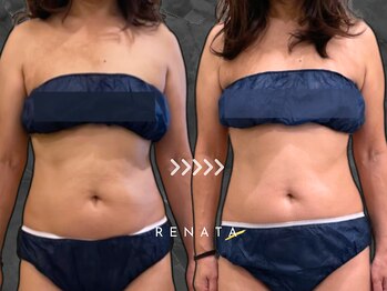 レナータ 池袋店(RENATA)/2ヵ月通い放題