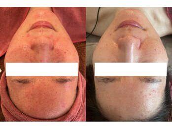 ビューティーマックス(Beauty Max)/フェイシャルbefore→after6ヶ月