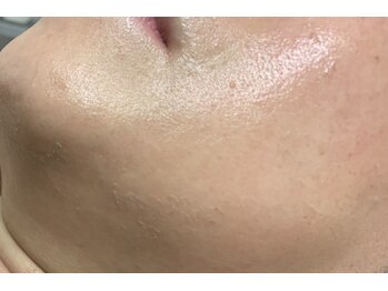 ブリリアンス(BRILLIANCE)/５日後はフェイシャルケア♪