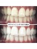 【当店人気No.3★】学割U24  セルフホワイトニング　50分　¥5000→¥2900