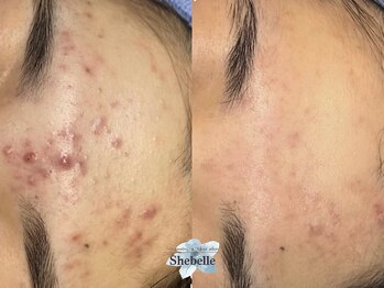 シーベル 代官山/症例写真/ハーブピーリング