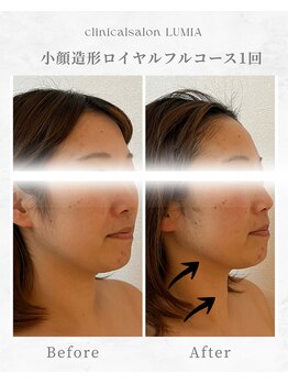 ルミア(LUMIA)/小顔造形ロイヤルフルコース１回