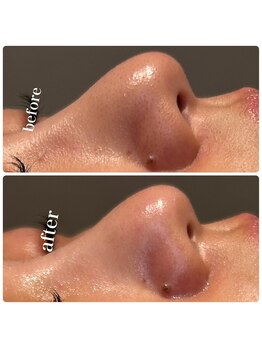 ディオーネ 春日井勝川店(Dione)/顔脱毛+毛穴洗浄