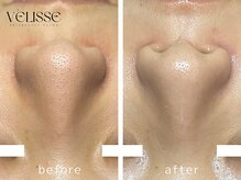 気になる毛穴も1回でここまでケア！