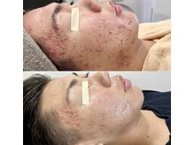ルミエール 札幌大通parkside店の雰囲気（肌荒れ相談も多数頂いています。一緒にキレイを目指しましょう！）