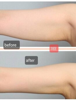 ビハダ(BeHADA)/#ダイエット/脂肪分解/引締