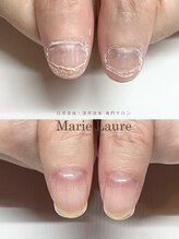 マリーロール 淀屋橋本店(Marie Laure)/自爪育成/深爪矯正/ネイルケア