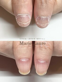 マリーロール 淀屋橋本店(Marie Laure)/自爪育成/深爪矯正/ネイルケア