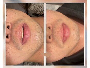 プルベル 平尾(Plus Belle)/ヒゲ脱毛