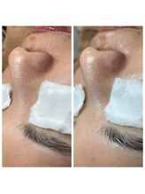 ラ ドウ 名古屋黒川店(la.dow)/ごっそりパック＆毛穴洗浄1回目