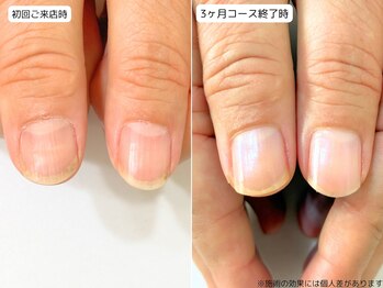 カピリナ(Ka Pilina)/自爪育成・深爪・川崎