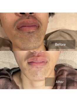 リエラ(Liella)/【メンズ】ヒゲ脱毛