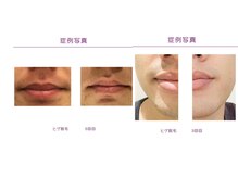 rvコーディネイトサロン(rv coordinate salon)/高出力LED脱毛を体験してみて♪