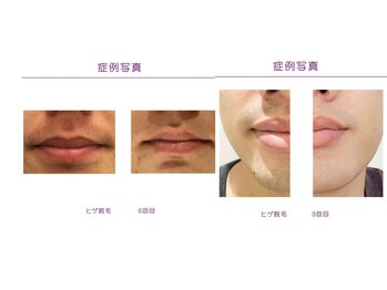 rvコーディネイトサロン(rv coordinate salon)/高出力LED脱毛を体験してみて♪