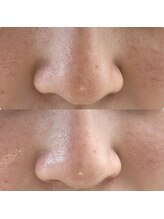 リンクアンドボーテ 大垣(Link&Beaute)/お悩み: 毛穴.くすみ　２０代